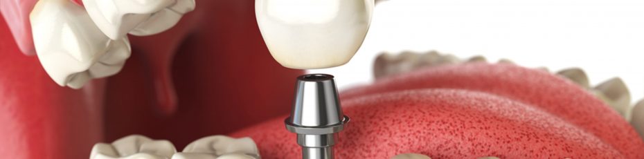 a more in depth look into dental implants