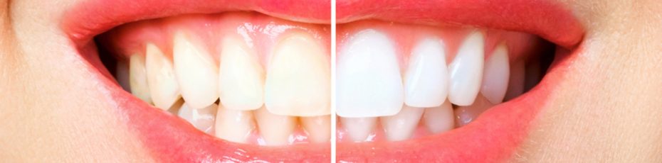 the complete guide to professional teeth whitening