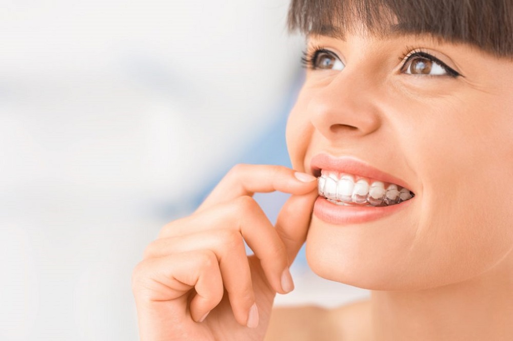 https://www.albanydental.ca/wp-content/uploads/2021/04/things-to-know-before-getting-invisalign.jpg