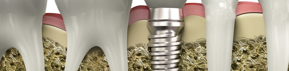 six easy ways to maintain your dental implants