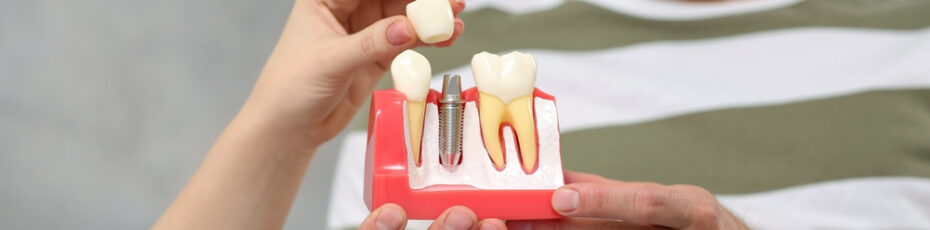 4 reasons why should you choose dental implants